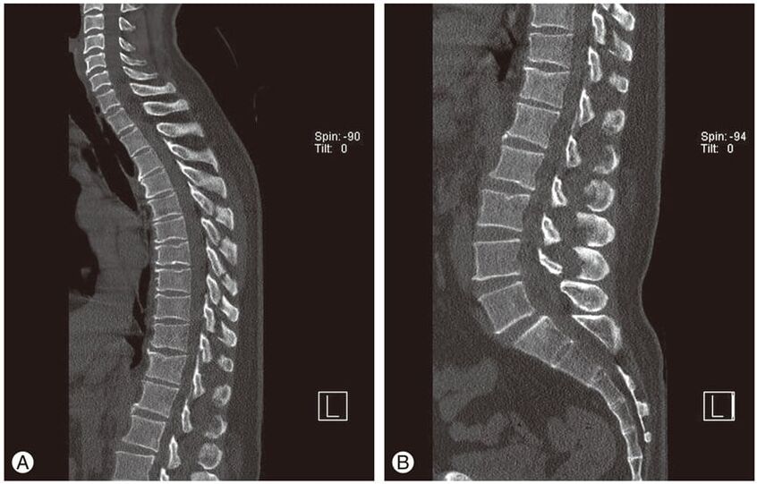 Starpskriemeļu disku deformācija MRI attēlos krūšu kurvja osteohondrozē