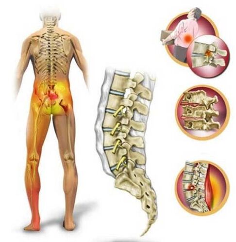Mugurkaula jostas daļas osteohondroze, kas izraisa muguras sāpes
