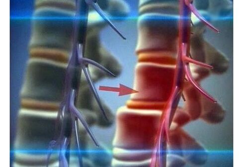 Nervu galu saspiešana jostas daļas osteohondrozē