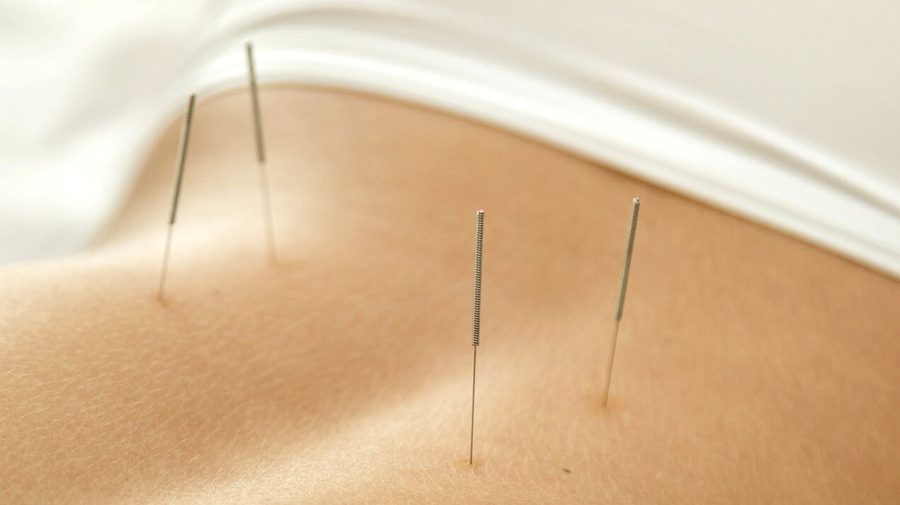 Akupunktūra palīdzēs atbrīvoties no sāpēm muguras lejasdaļā
